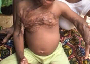Dabompa : Maxime Kolié, un enfant de 2 ans, souffre gravement de brûlures suite à un accident tragique