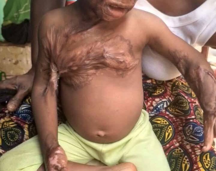 Dabompa : Maxime Kolié, un enfant de 2 ans, souffre gravement de brûlures suite à un accident tragique