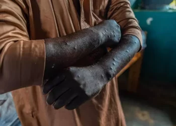 Guinée : 18 cas de Mpox confirmés